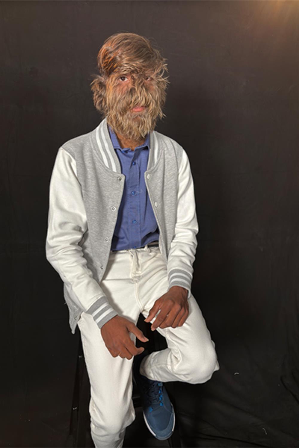 Ρεκόρ Γκίνες - Τριχωτό πρόσωπο - Lalit Patidar Ρεκόρ Γκίνες - Τριχωτό πρόσωπο - Lalit Patidar