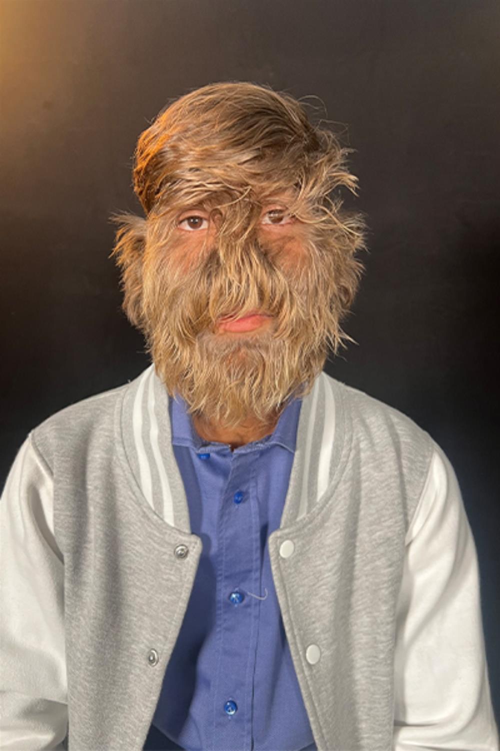 Ρεκόρ Γκίνες - Τριχωτό πρόσωπο - Lalit Patidar Ρεκόρ Γκίνες - Τριχωτό πρόσωπο - Lalit Patidar