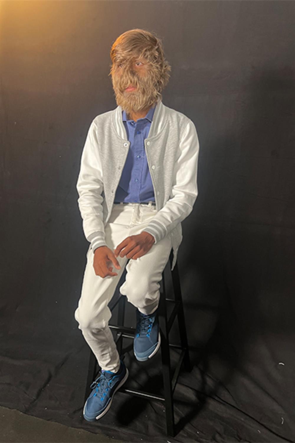 Ρεκόρ Γκίνες - Τριχωτό πρόσωπο - Lalit Patidar Ρεκόρ Γκίνες - Τριχωτό πρόσωπο - Lalit Patidar