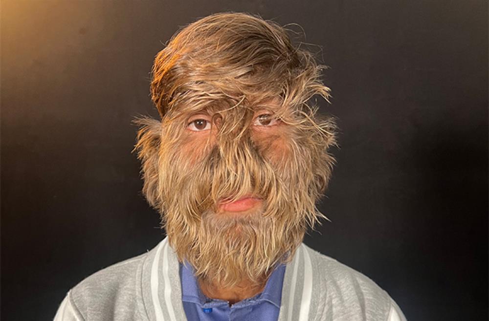 Ρεκόρ Γκίνες - Τριχωτό πρόσωπο - Lalit Patidar Ρεκόρ Γκίνες - Τριχωτό πρόσωπο - Lalit Patidar