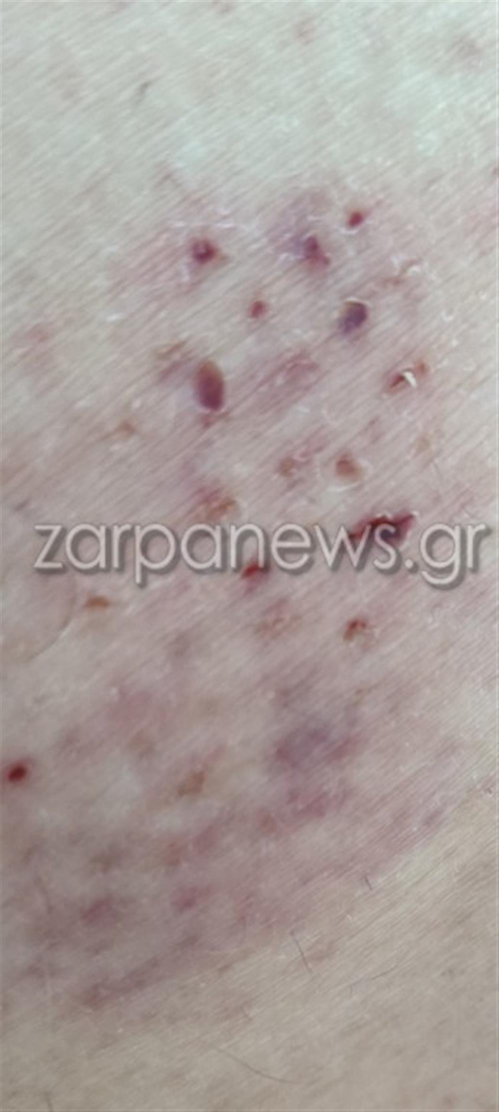 δάγκωμα χελώνας Χανιά δάγκωμα χελώνας Χανιά